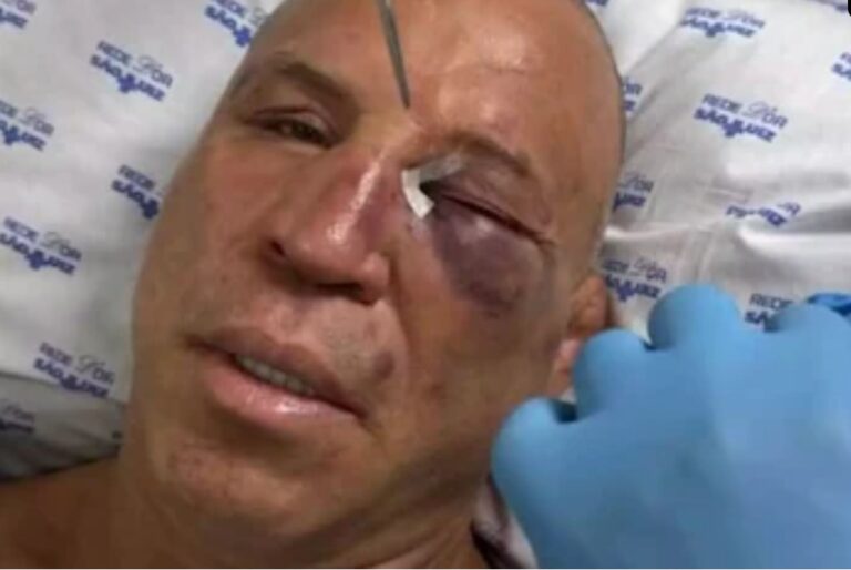 Wanderlei Silva sofre fratura no nariz após confusão